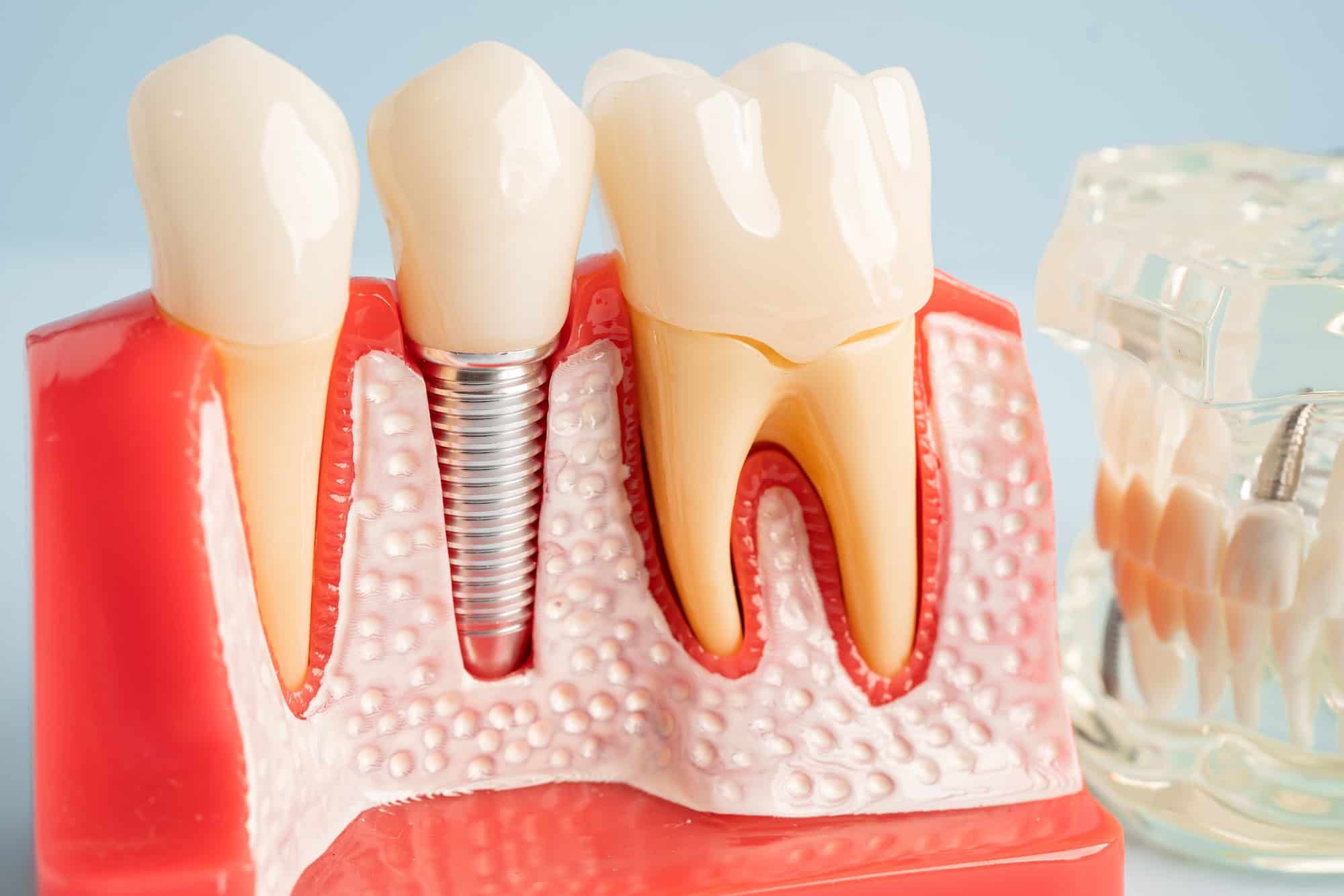 Negative Effects of Dental Implants