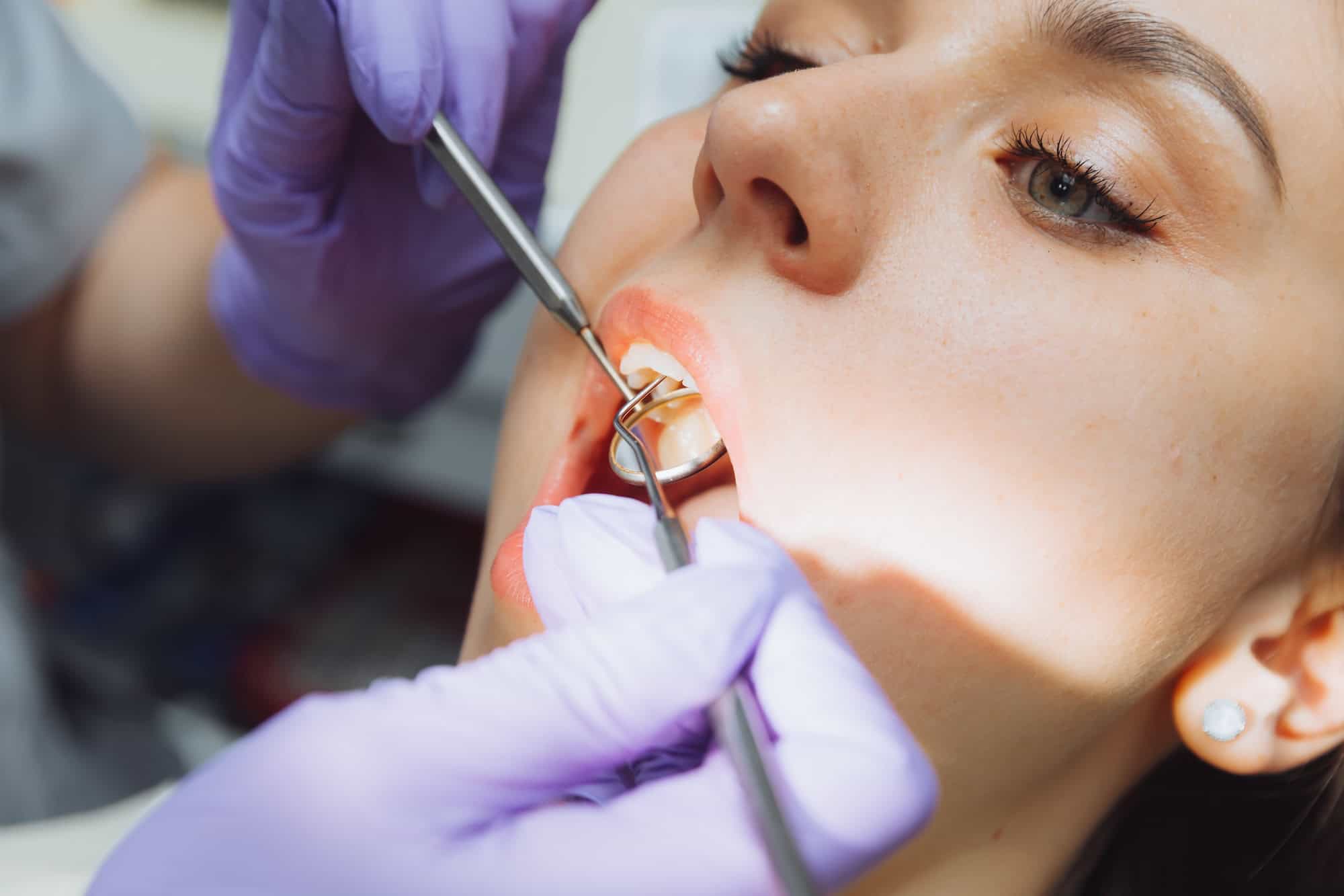 Tooth Removal After a Crown or Root Canal