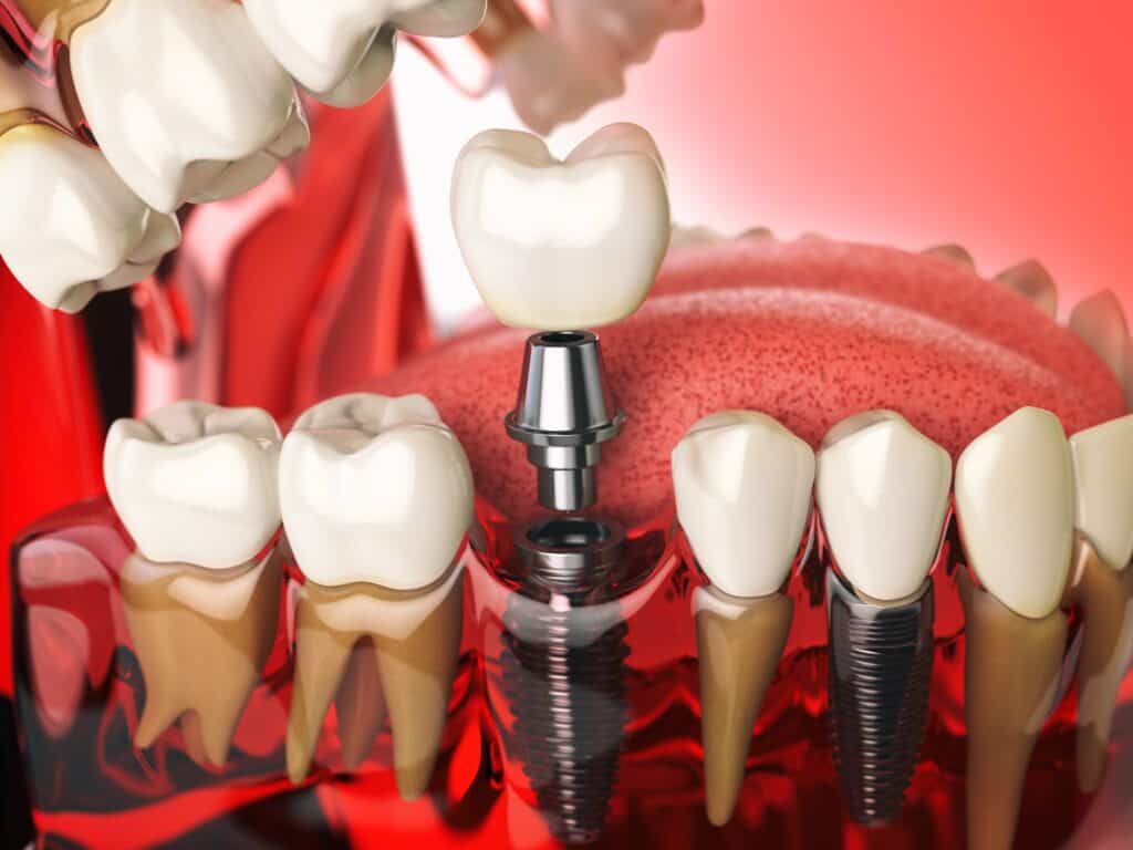 Do I Need a Dental Implant