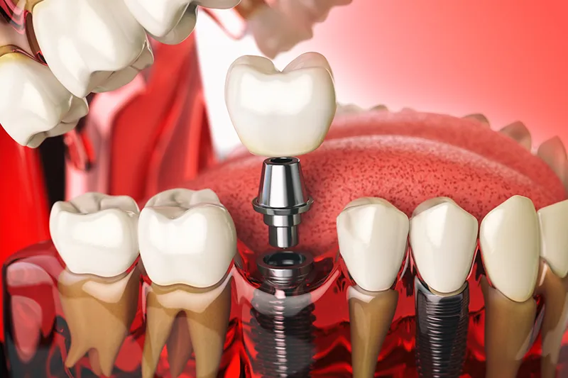 Tooth replacement options