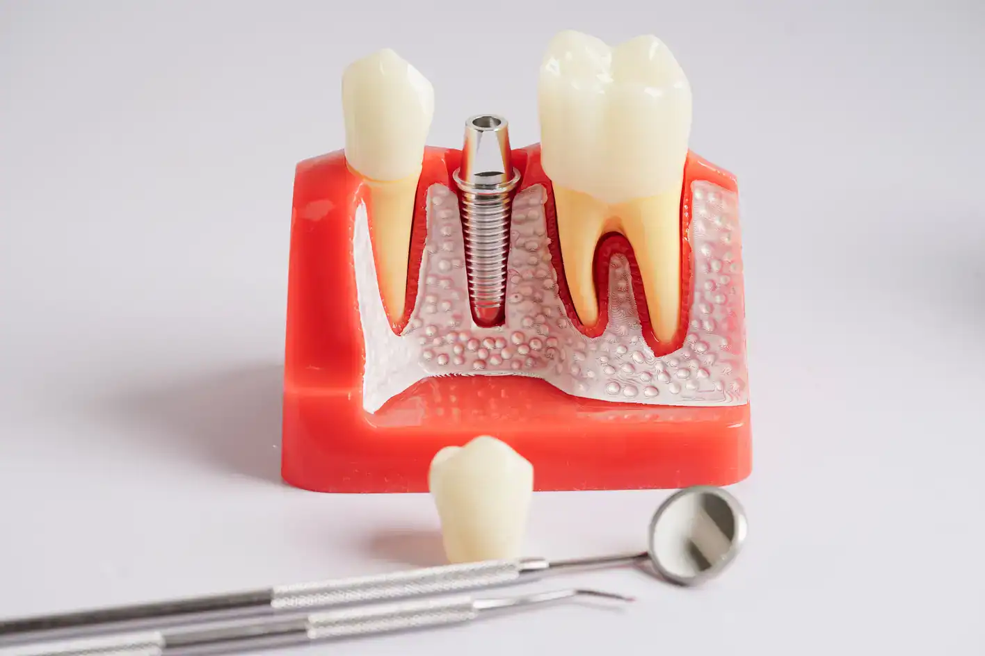 Affordable dental implants Tulsa - low-cost dental implant model demonstration