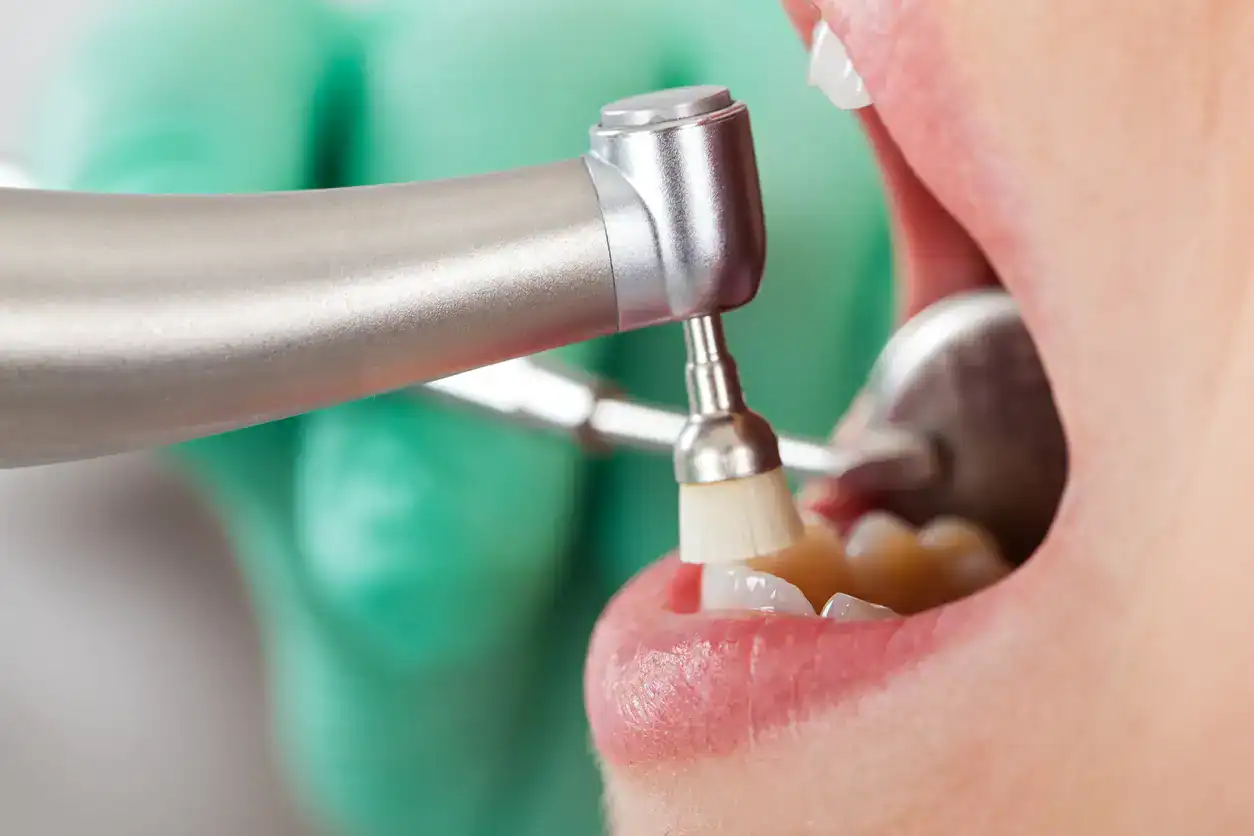 Routine dental cleaning Tulsa - best dental hygienist performing dental cleanings